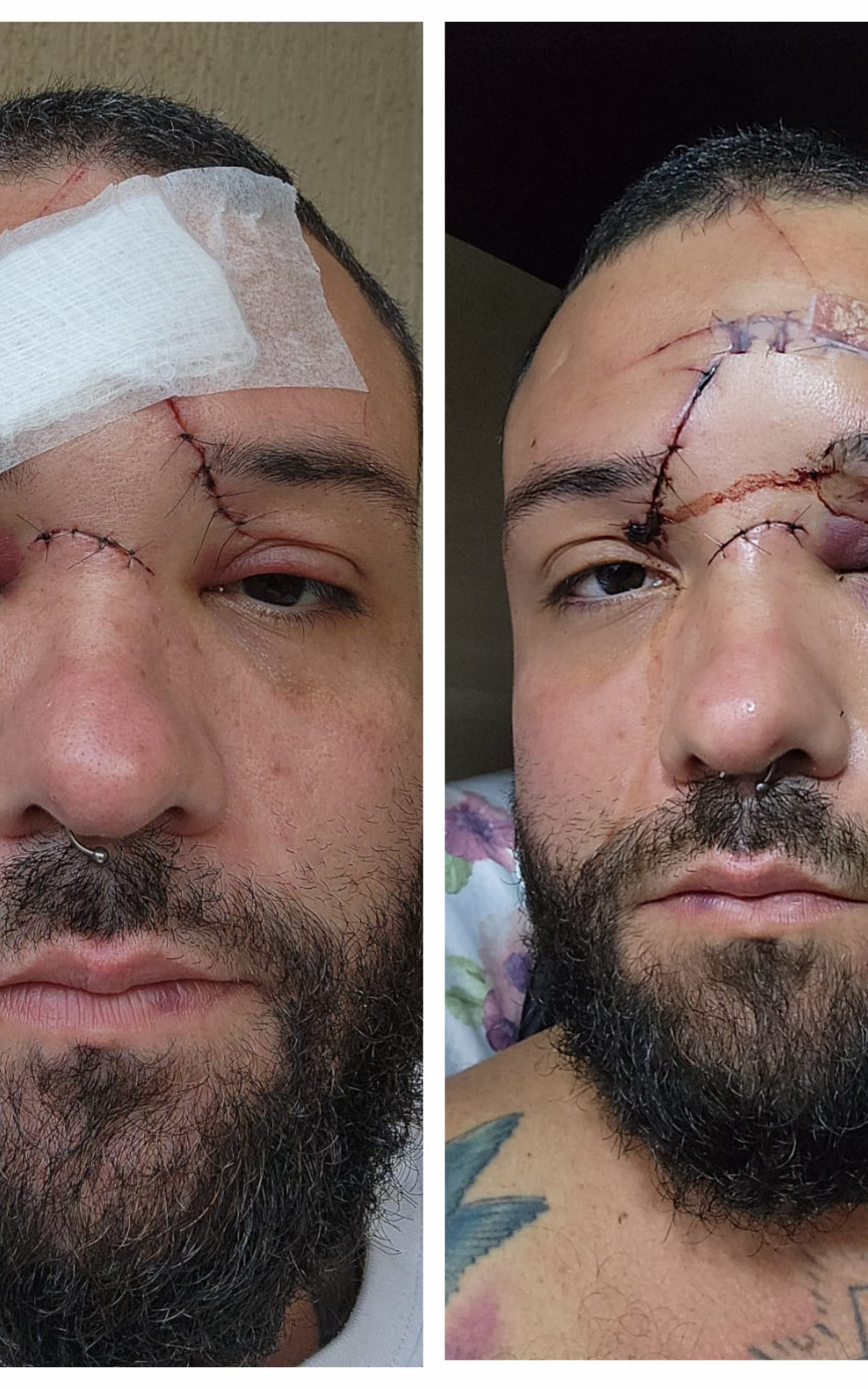 Michel Cardoso teve diversos cortes no rosto - Arquivo Pessoal