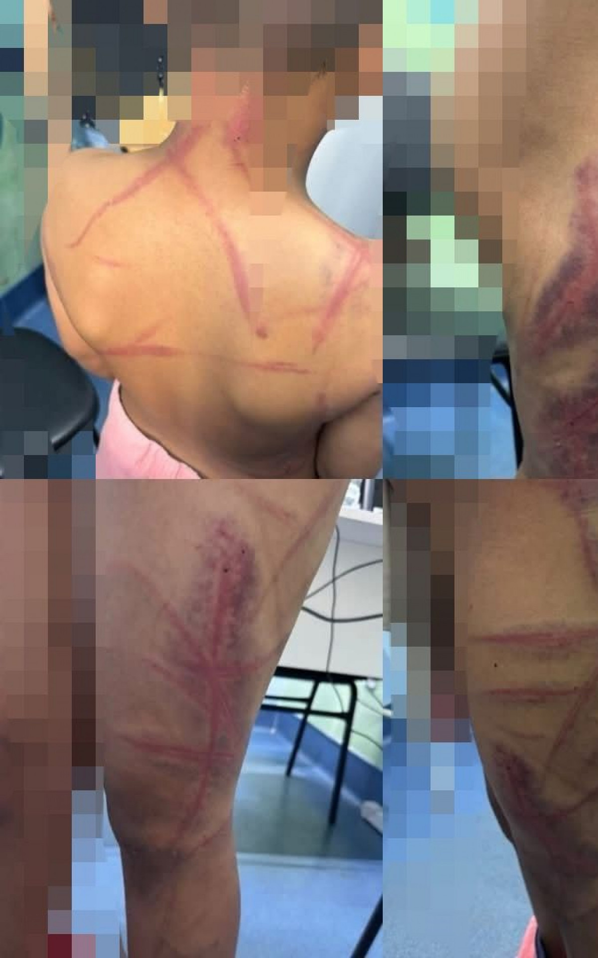 Crian&ccedil;a ficou com diversos hematomas pelo corpo - Rede Social