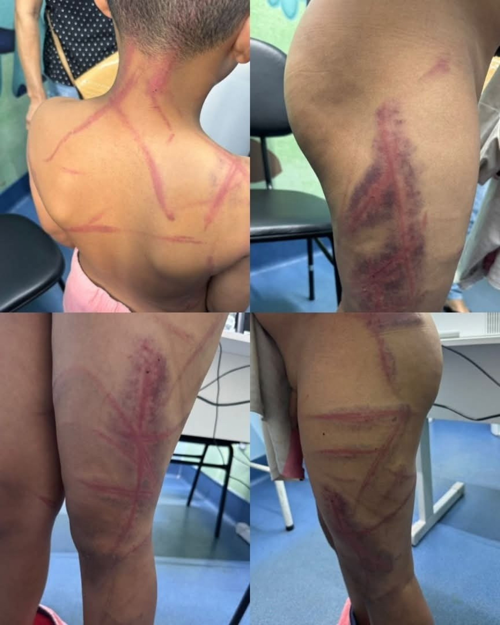 Criança ficou com diversos hematomas pelo corpo