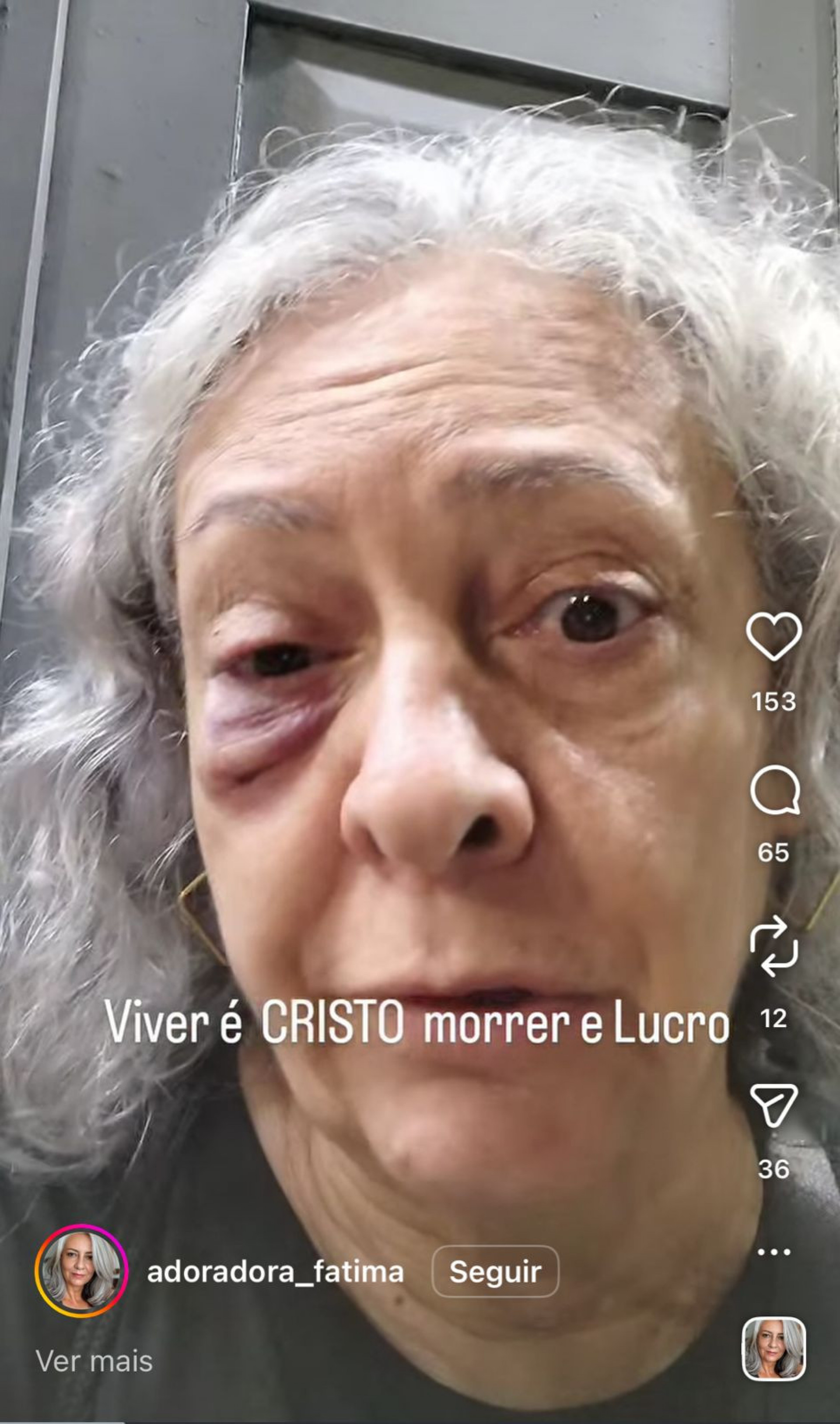 Idosa ficou com um olho roxo  - Divulgação/ Redes Sociais