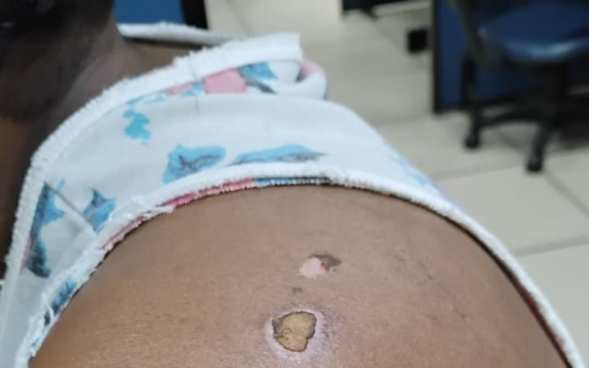 A v&iacute;tima teve o cabelo cortado, foi mordida e agredida diversas vezes