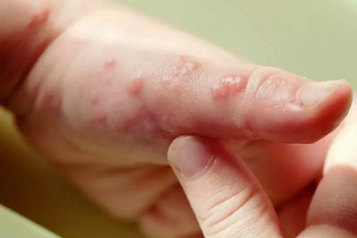 Câmara aprova pensão vitalícia de salário mínimo para pessoas com epidermólise bolhosa