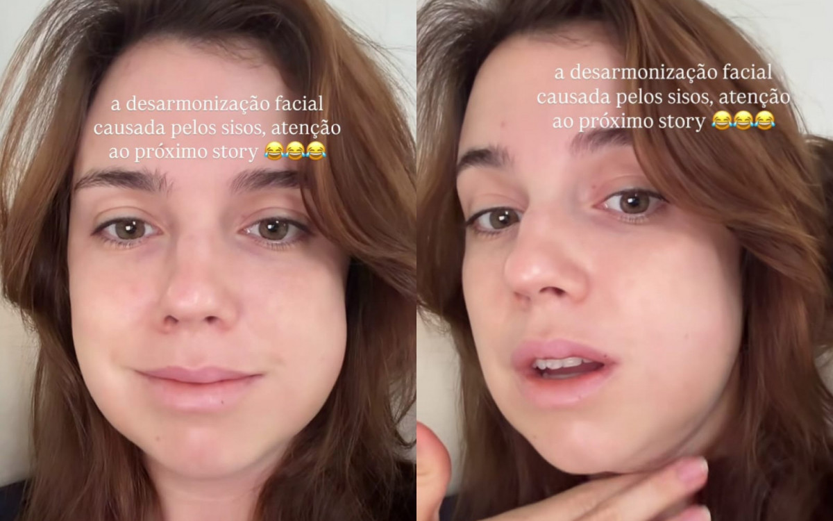 Alice Wegmann brinca sobre rosto inchado depois de retirar sisos: 'Desarmonização facial'