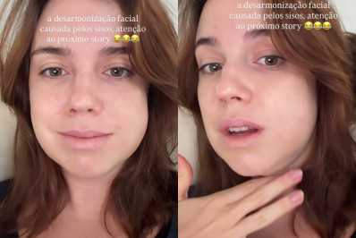 Alice Wegmann brinca sobre rosto inchado depois de retirar sisos: 'Desarmonização facial'