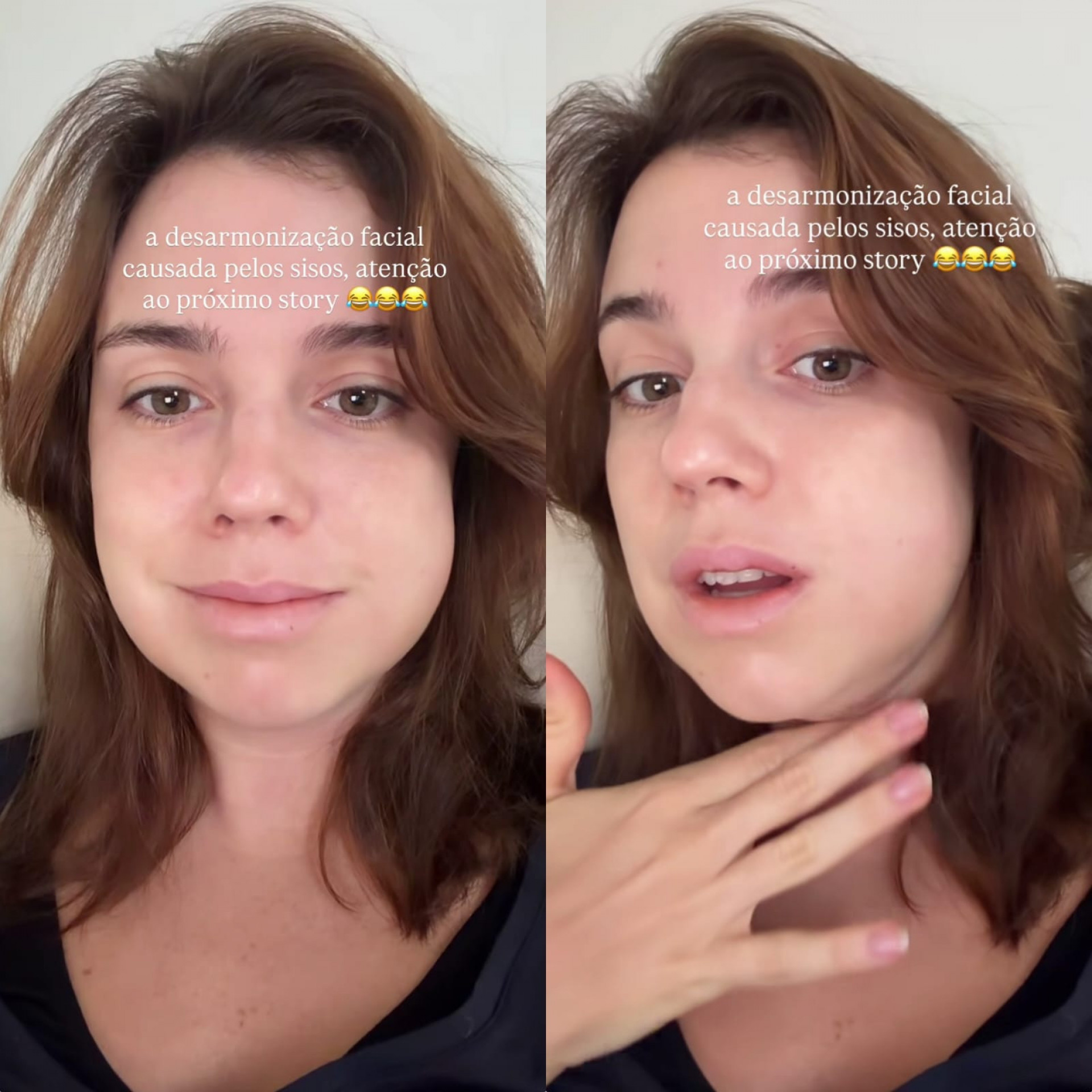 Alice Wegmann brinca sobre rosto inchado depois de retirar sisos: 'Desarmonização facial' - Reprodução de vídeo / Instagram