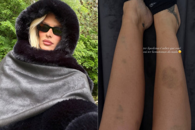 Yasmin Brunet exibe hematomas do lipedema: 'Do nada'