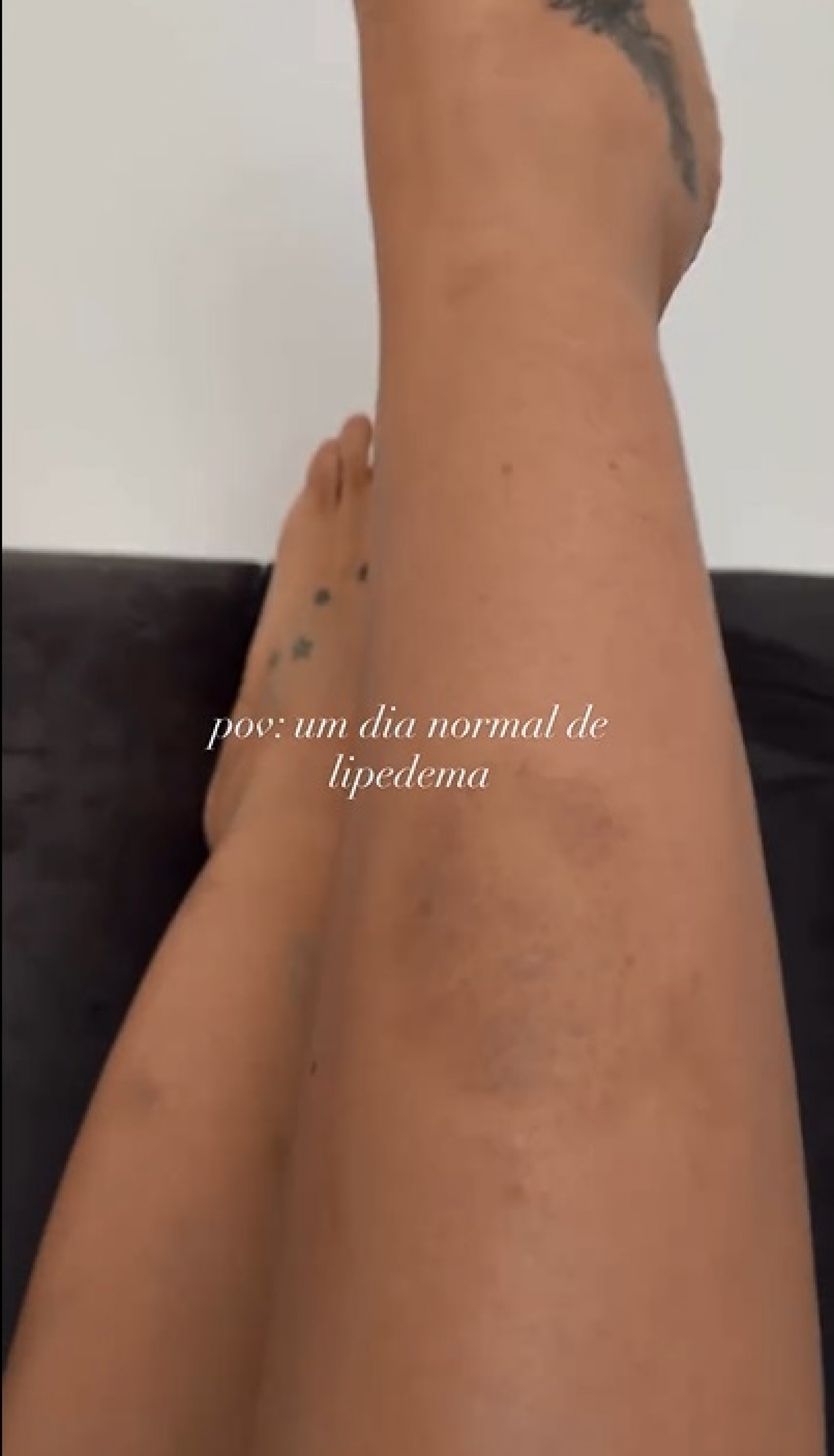 Yasmin Brunet mostrou hematomas nas pernas causados pelo lipedema  - Reprodução/Instagram