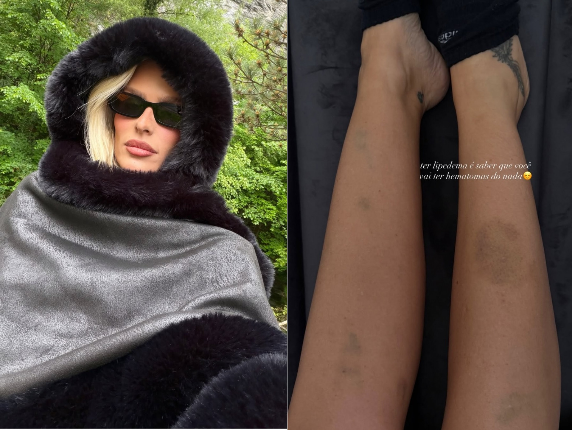 Yasmin Brunet exibe hematomas do lipedema: 'Do nada'