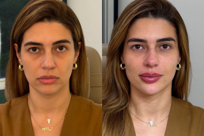 Vivian Amorim exibe antes e depois de harmonização facial