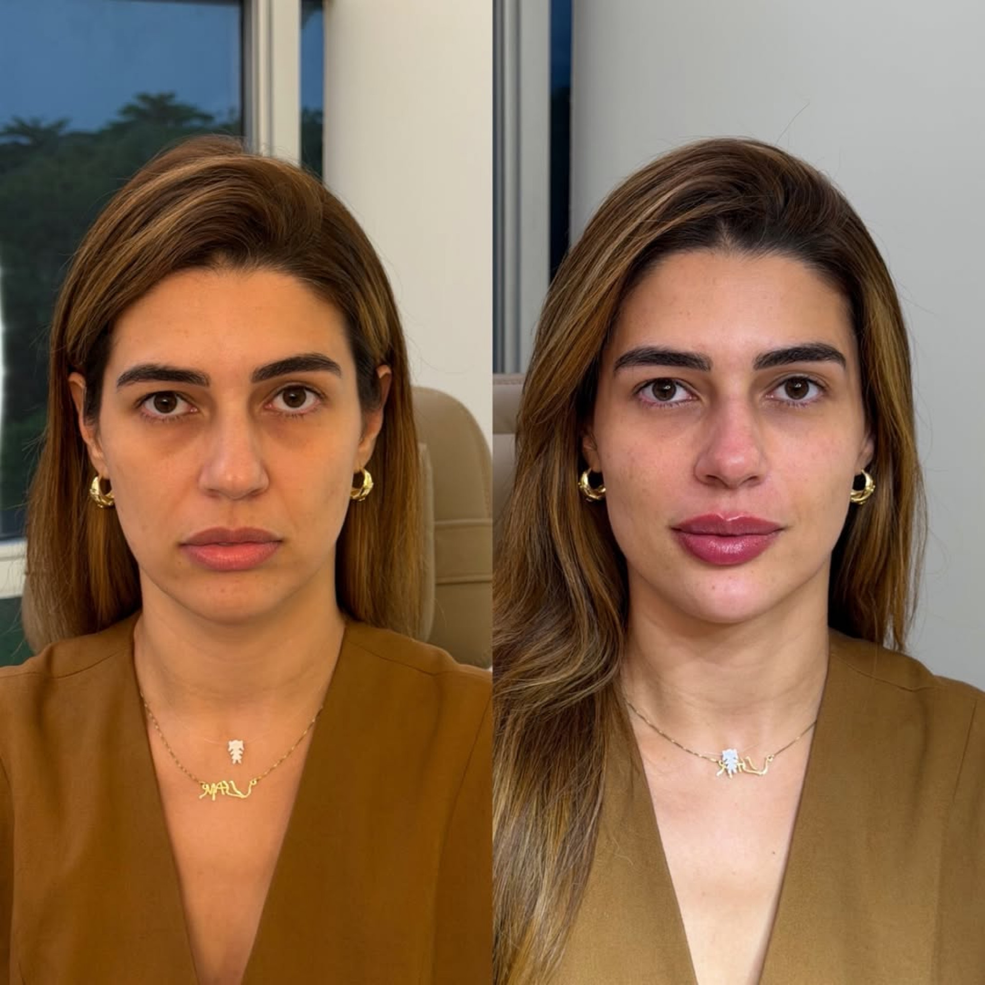 Vivian Amorim exibiu resultado de procedimento estético  - Reprodução/Instagram