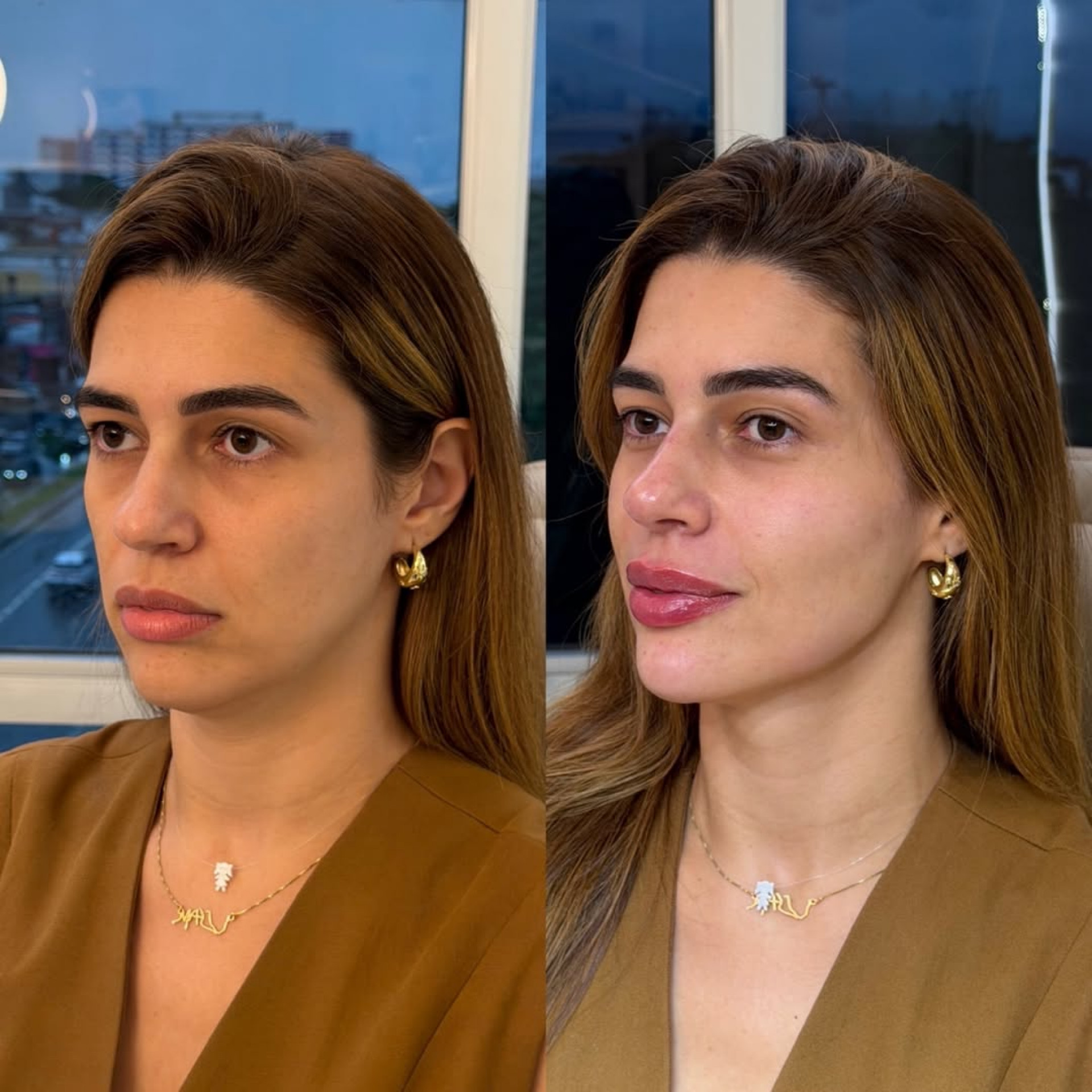 Vivian Amorim revelou antes e depois de harmonização facial  - Reprodução/Instagram