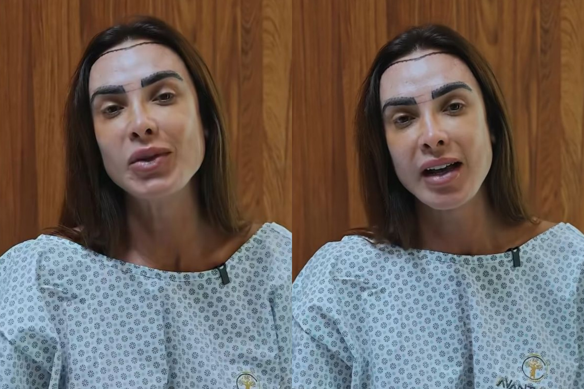 Nicole Bahls faz transplante capilar após alopecia: 'Mais cabeluda'