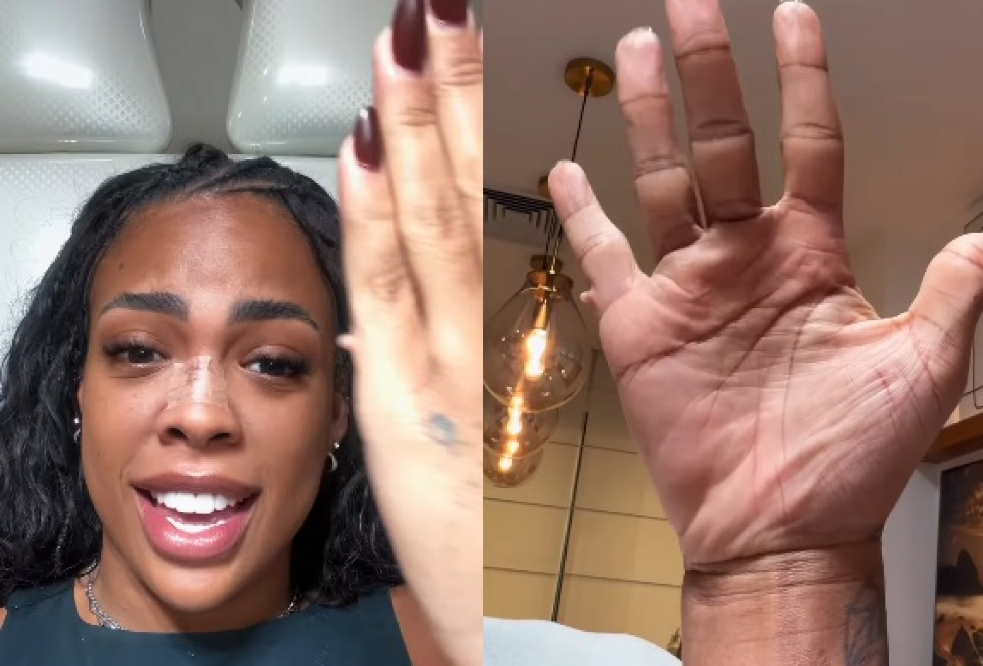 Marvvila realiza cirurgia para remoção do sexto dedo - Reprodução do Instagram