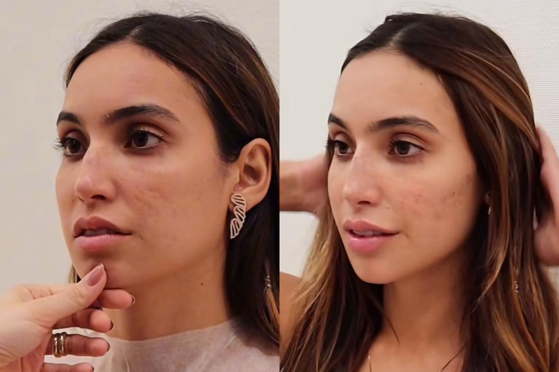 Vanessa Lopes mostra antes e depois de procedimentos no rosto - Reprodução / Instagram