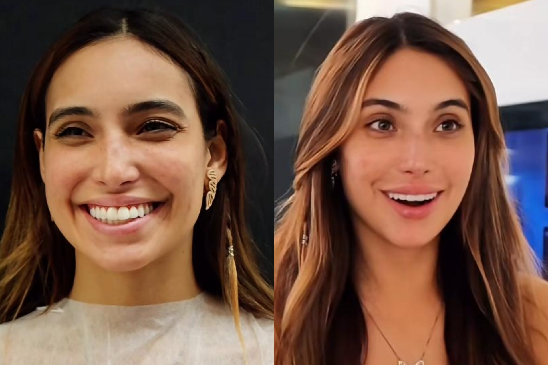 Vanessa Lopes mostra antes e depois de procedimentos no rosto - Reprodução / Instagram