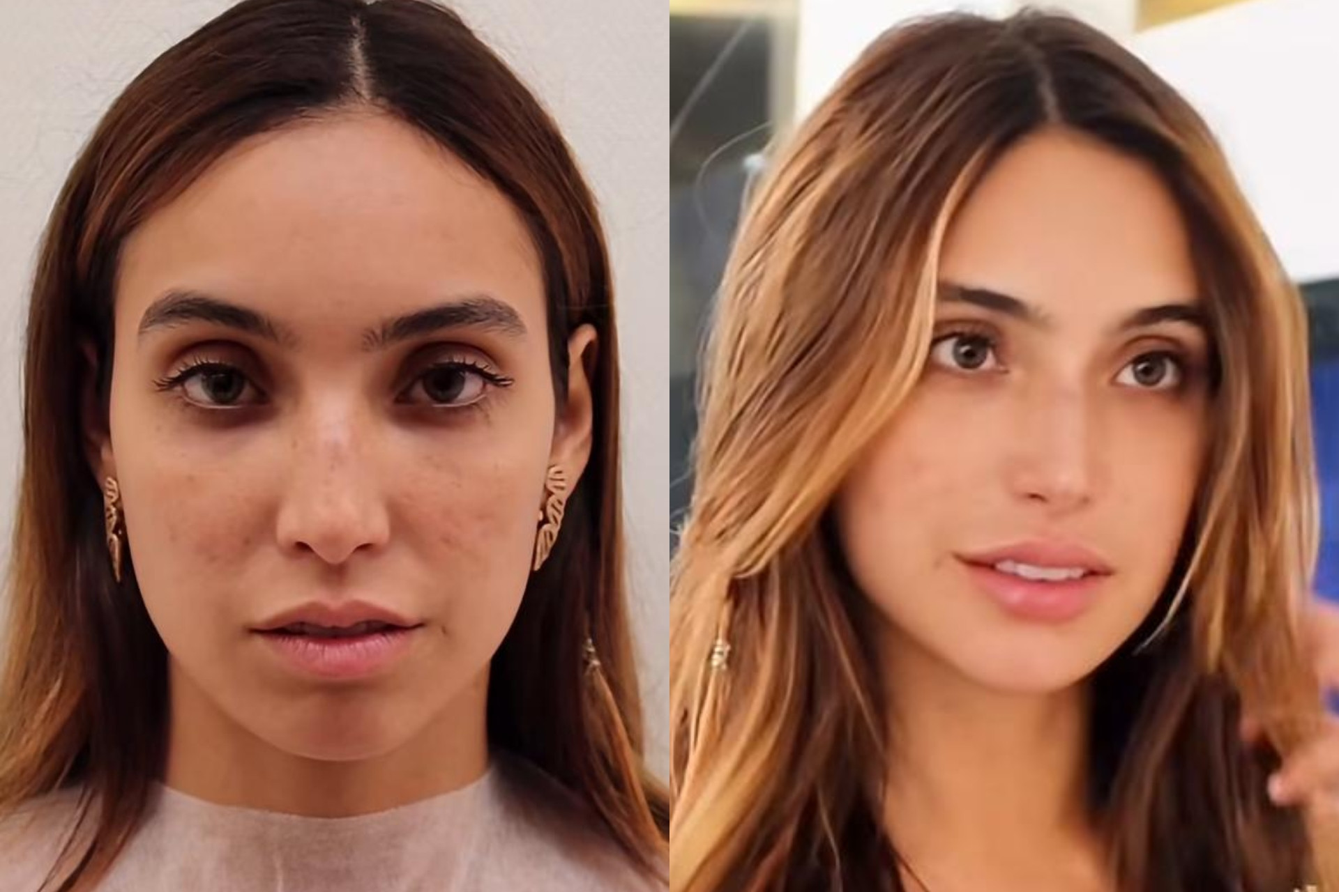 Vanessa Lopes mostra antes e depois de procedimentos no rosto - Reprodução / Instagram