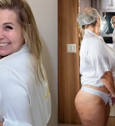Andréa Sorvetão<br>trata celulite após<br>perder 20 kg