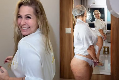 Andréa Sorvetão passa por tratamento para celulite após perder 20 kg