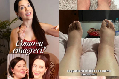 Ex-BBB mostra antes e depois do tratamento de lipedema: 'Sofri'