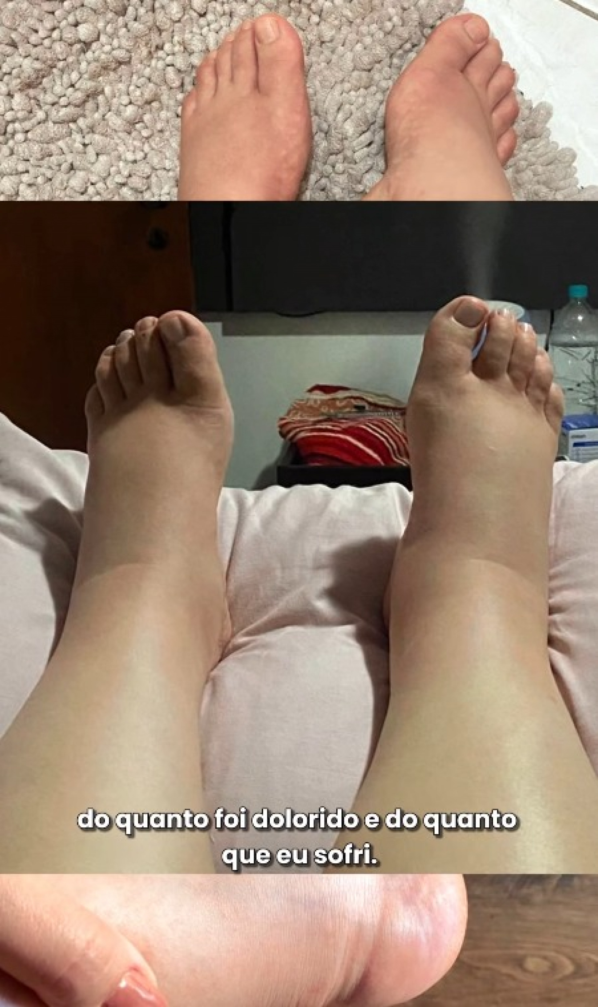 Andressa Ganacin mostrou antes e depois do tratamento de lipedema - Reprodução / Instagram