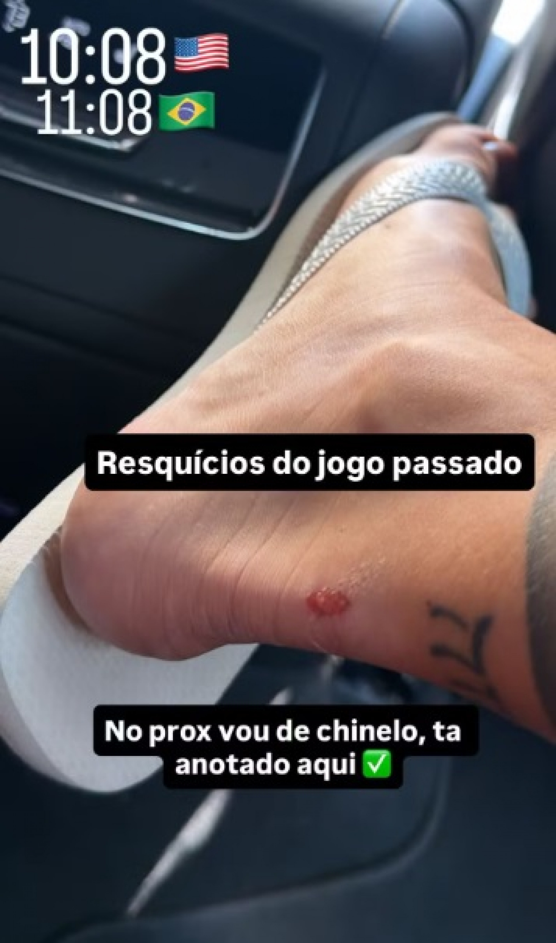 Virginia exibe ferimento no pé após jogos do Brasil