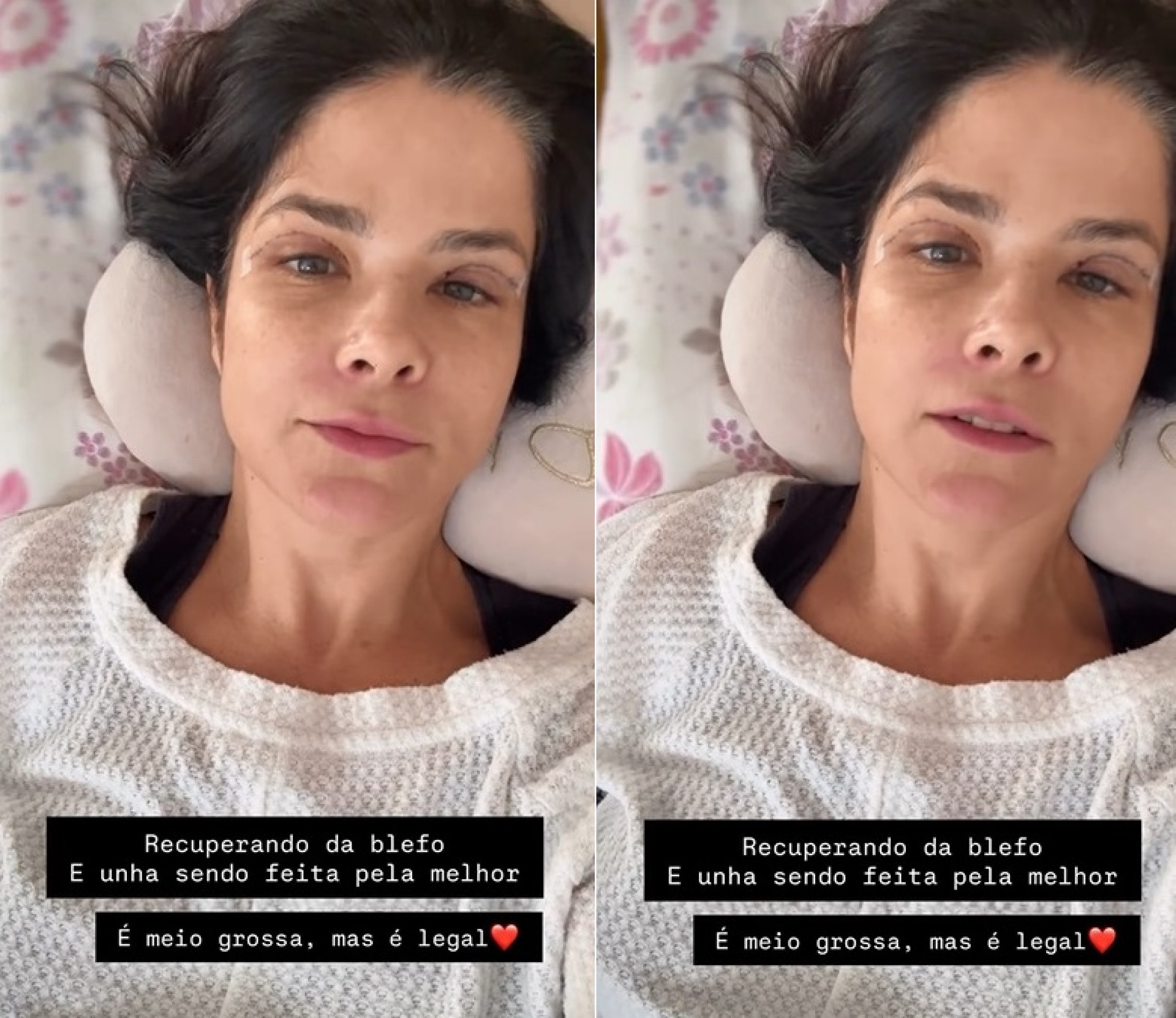 Samara Felippo se recupera de uma blefaroplastia - Reprodução/Instagram