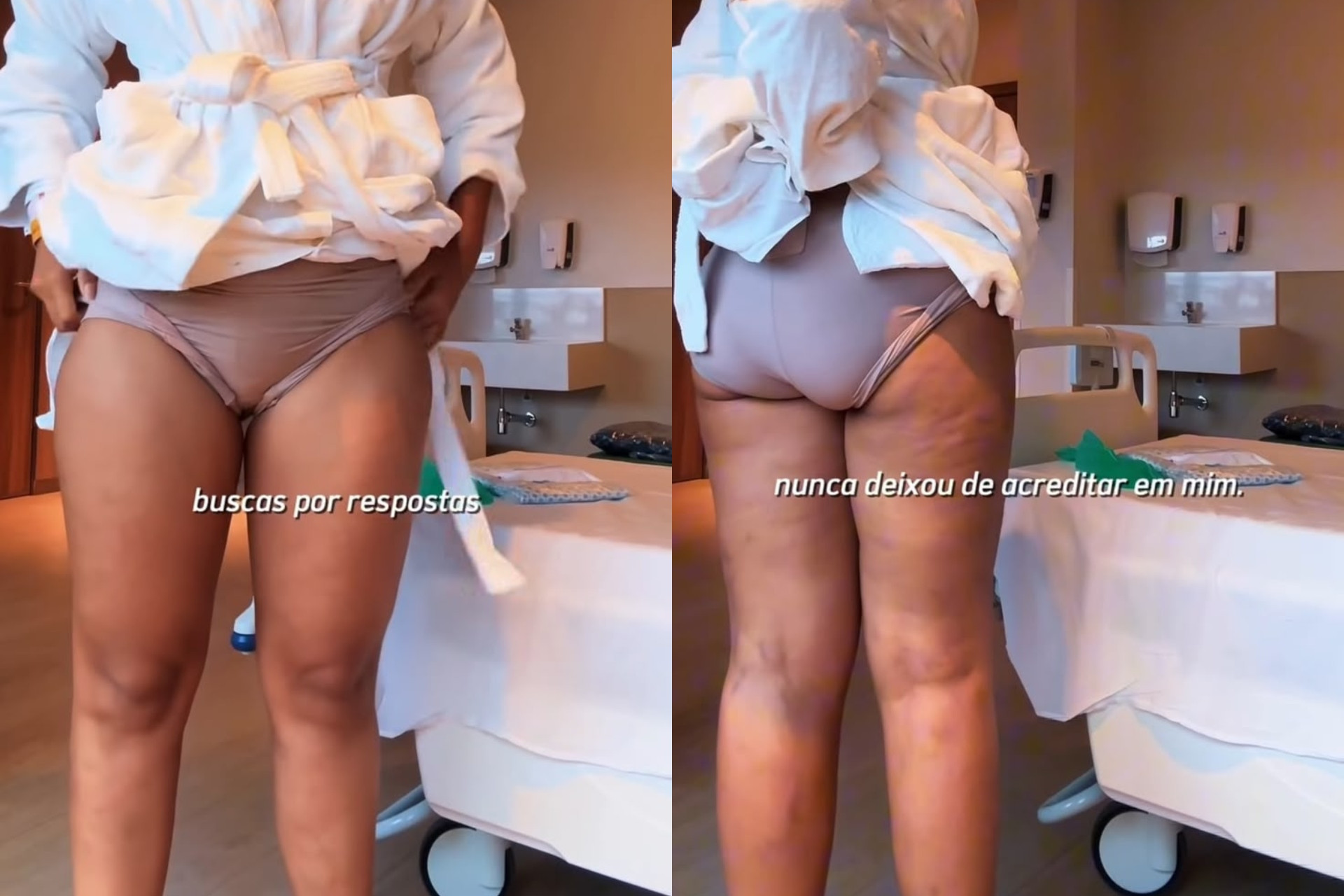 Antes da cirurgia de lipedema de Barbara Reis - Reprodução / Instagram