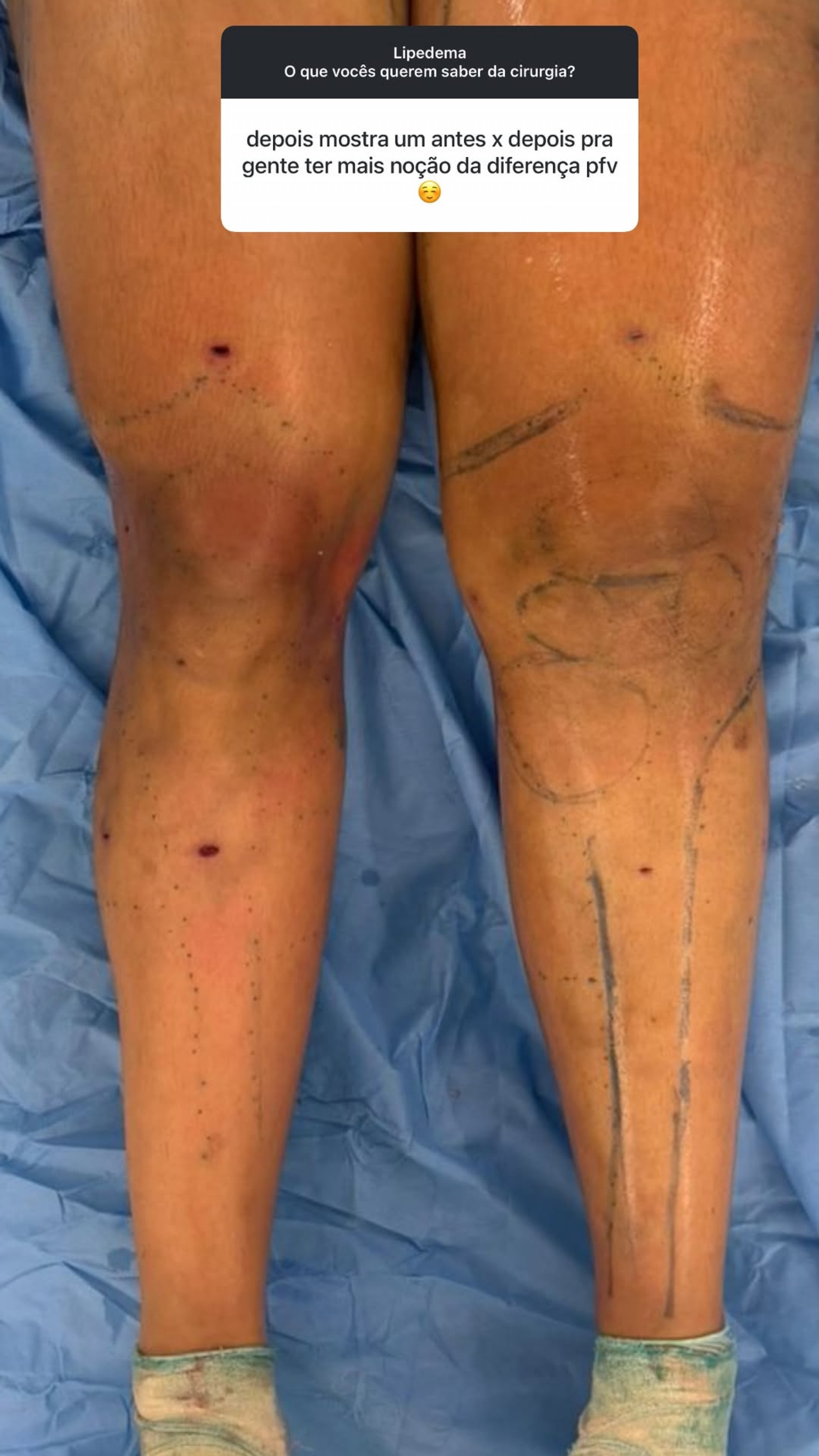 Antes e depois da cirurgia de lipedema de Barbara Reis - Reprodução / Instagram