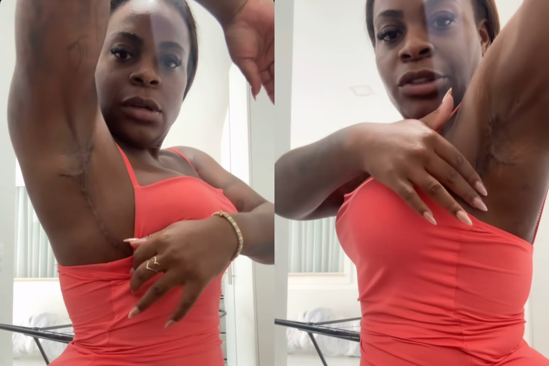 Jojo Todynho exibe cicatrizes após cirurgias reparadoras. - Reprodução / Instagram