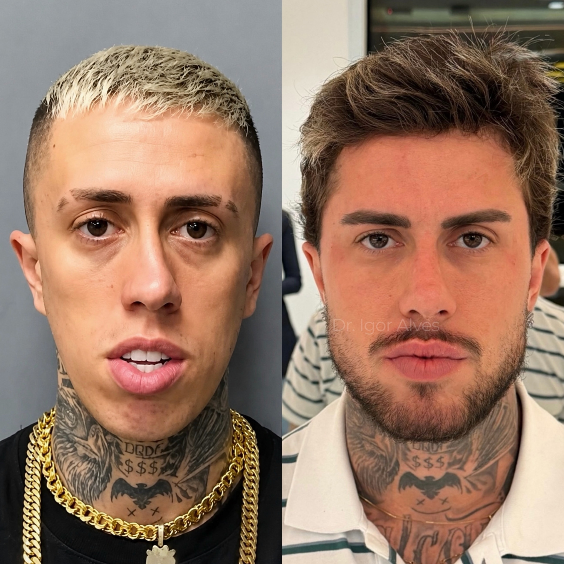 MC Daniel posta antes e depois de harmonização facial  - Reprodução / Instagram