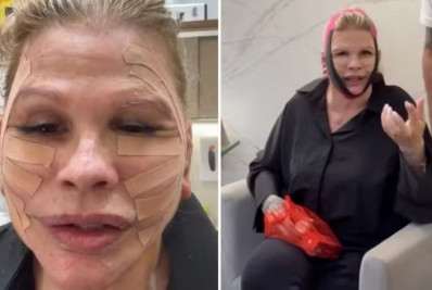 Após lifting facial, Monique Evans surge com rosto enfaixado