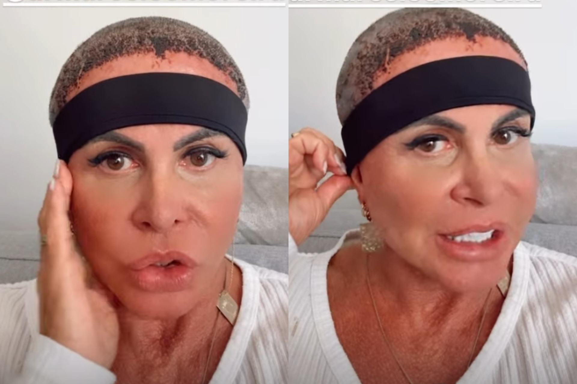 Gretchen exibe resultado inicial de transplante capilar - Reprodução / Instagram