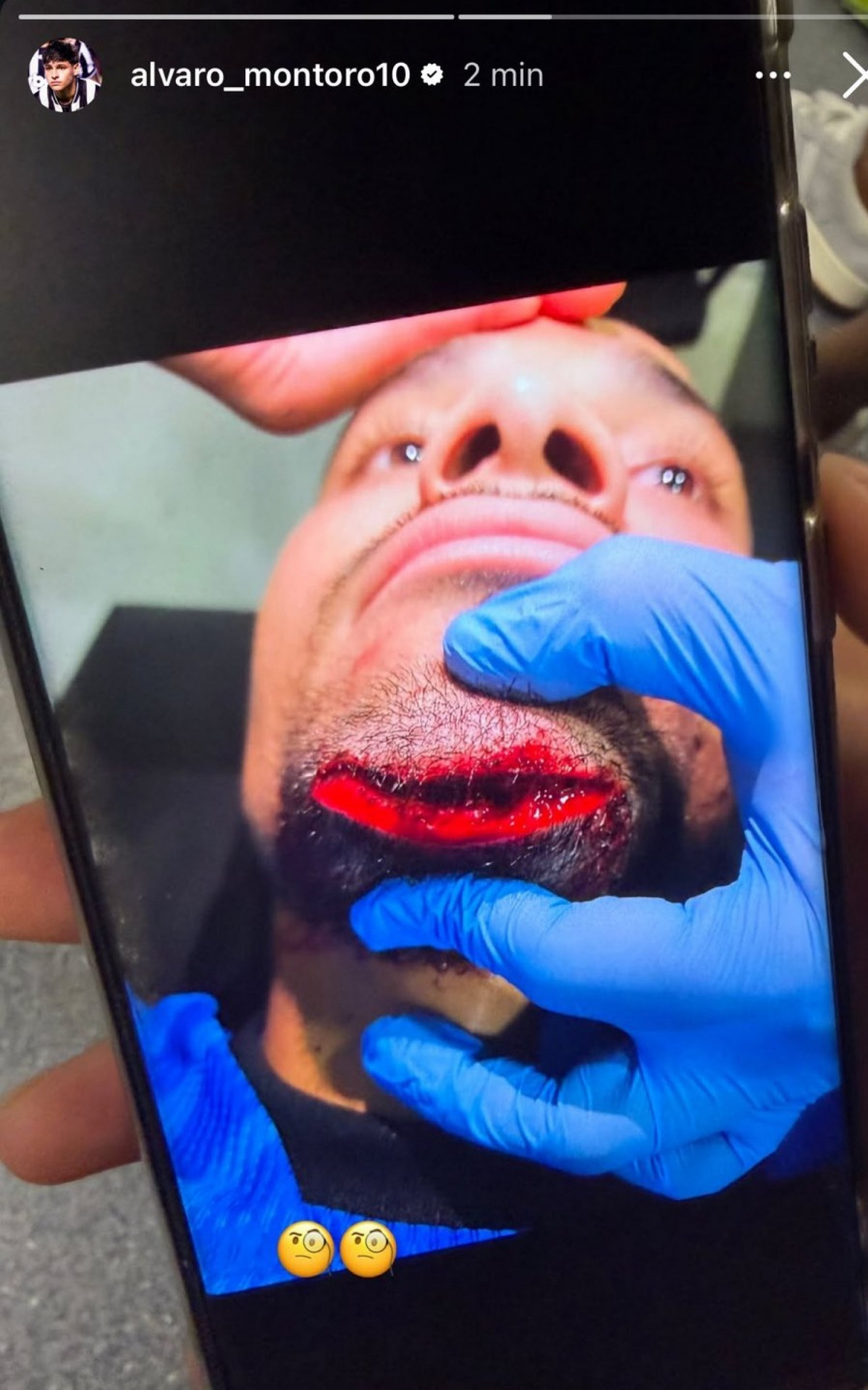Montoro compartilhou foto de como ficou o queixo de Warleson - Reprodu&ccedil;&atilde;o de Instagram