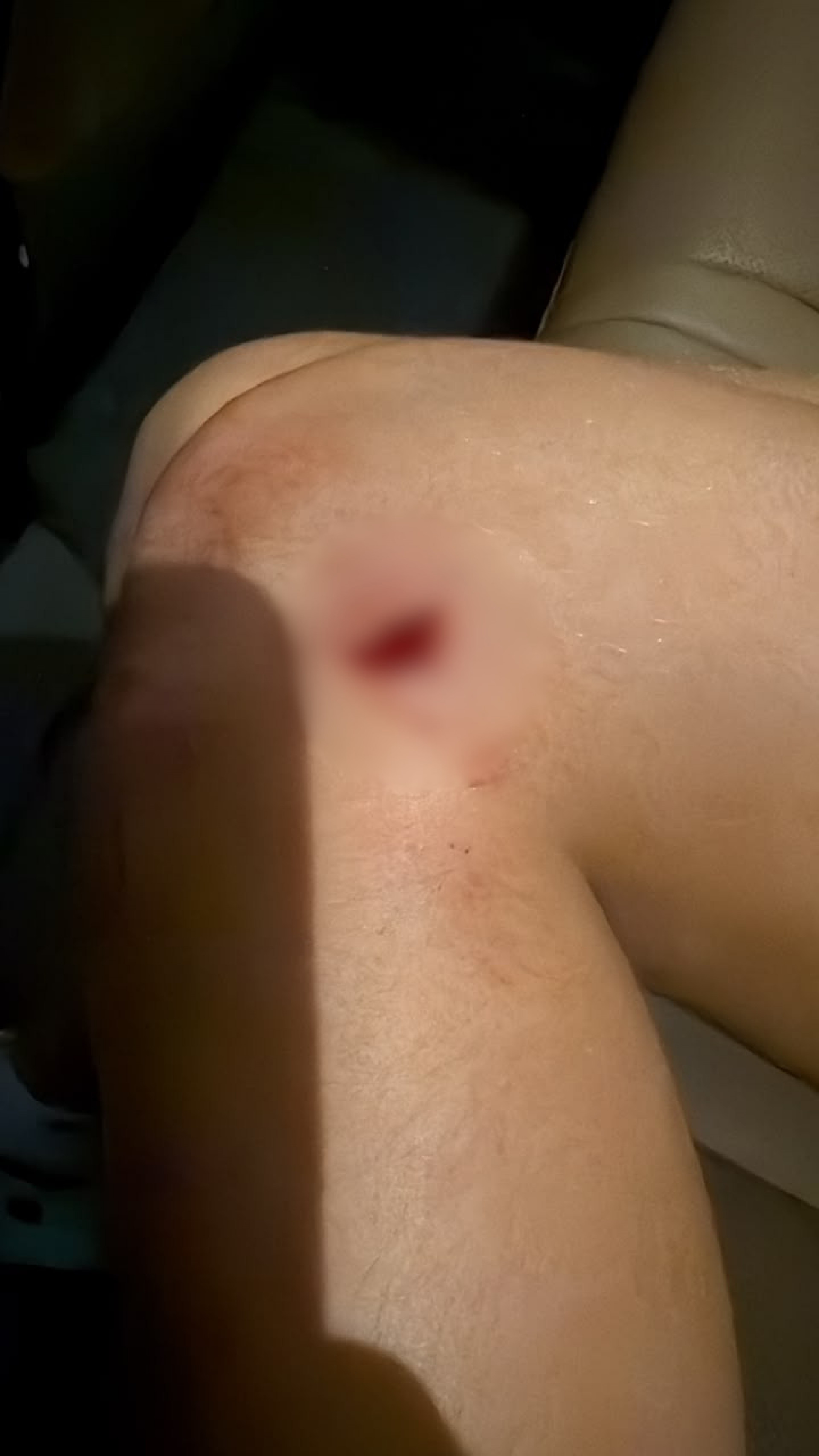 Menina ficou com cortes e uma lesão no pulmão, além de hematomas pelo corpo - Arquivo pessoal