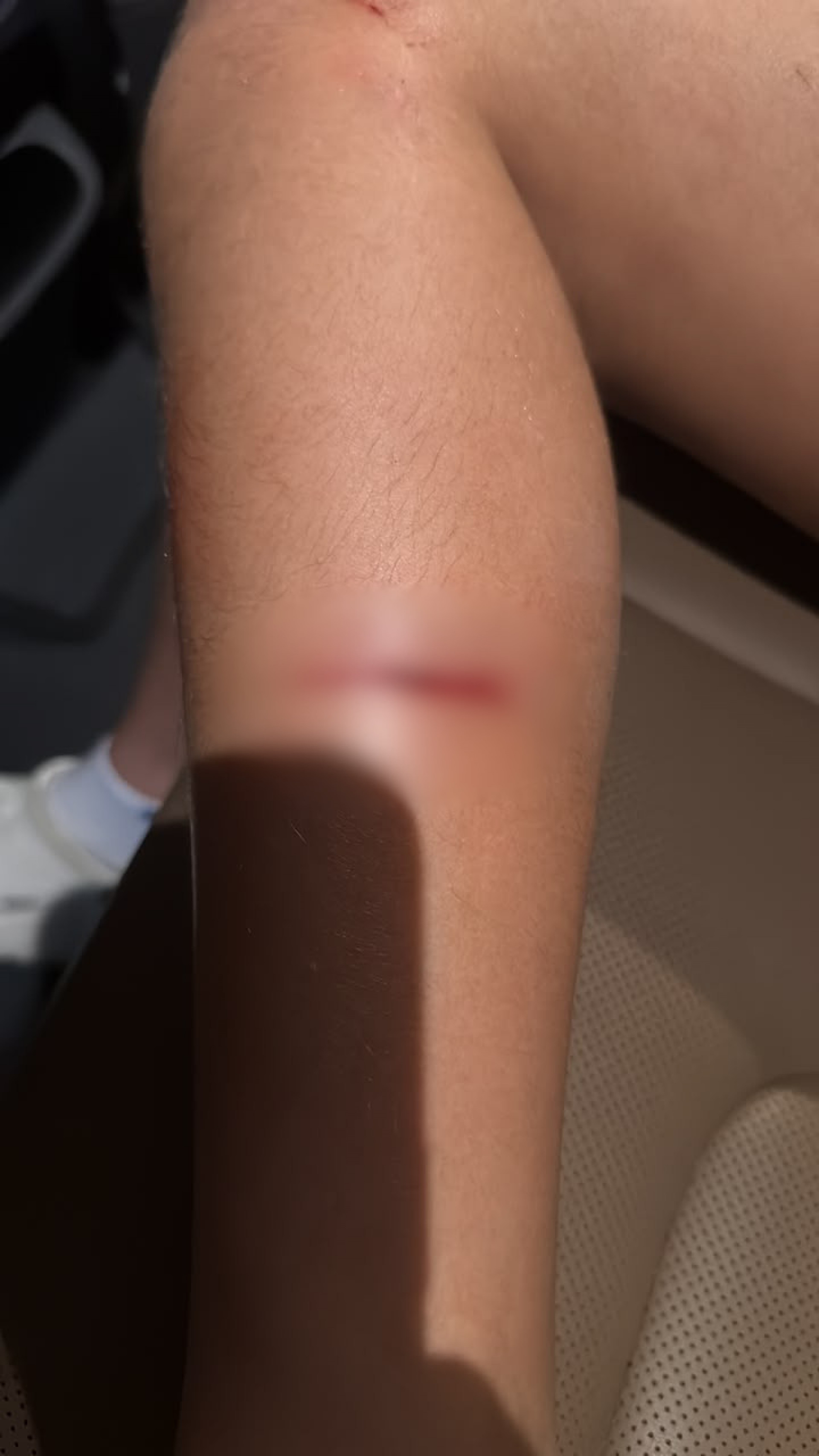 Menina ficou com cortes e uma lesão no pulmão, além de hematomas pelo corpo - Arquivo pessoal