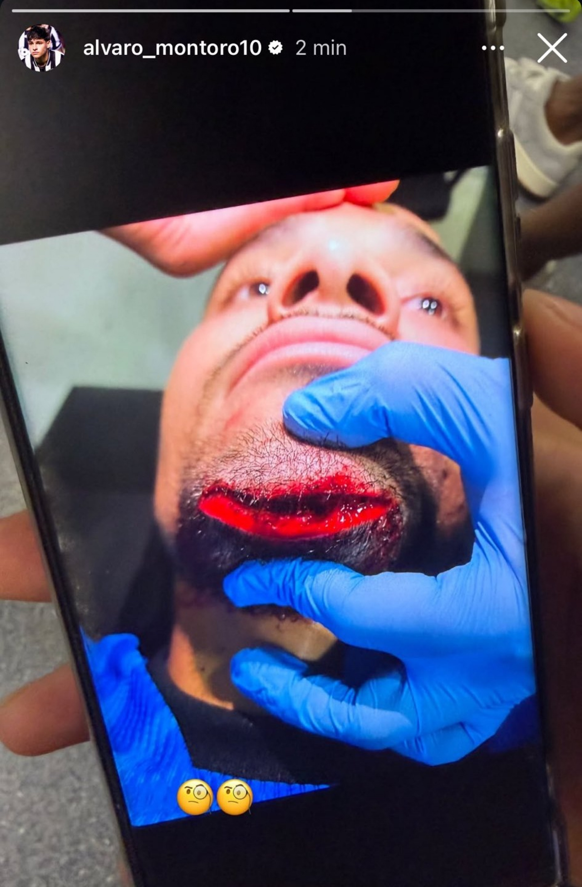 Montoro compartilhou foto de como ficou o queixo de Warleson