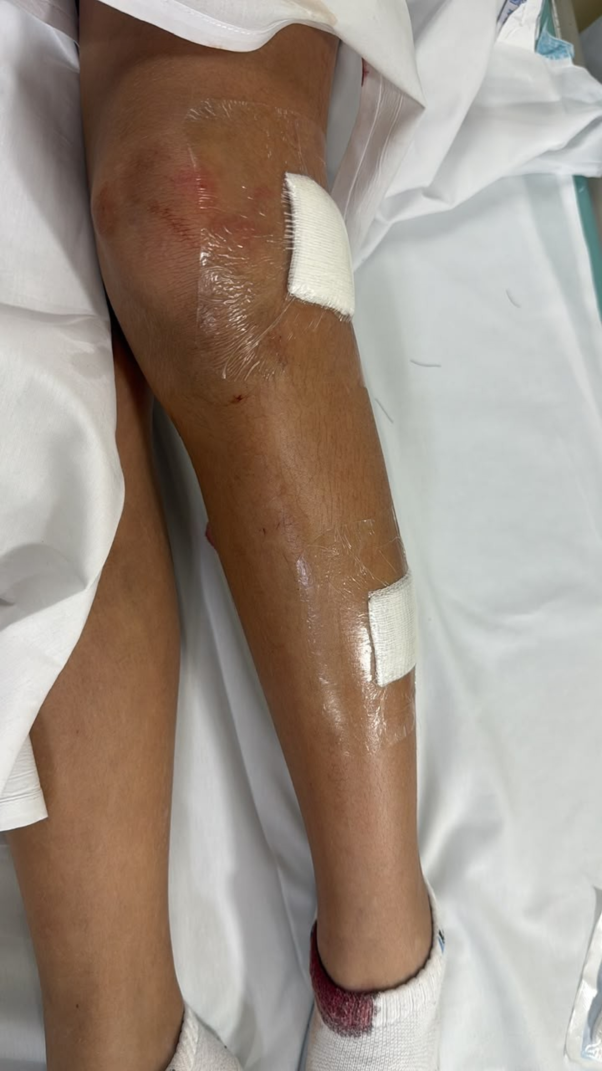 Menina ficou com cortes e uma lesão no pulmão, além de hematomas pelo corpo - Arquivo pessoal