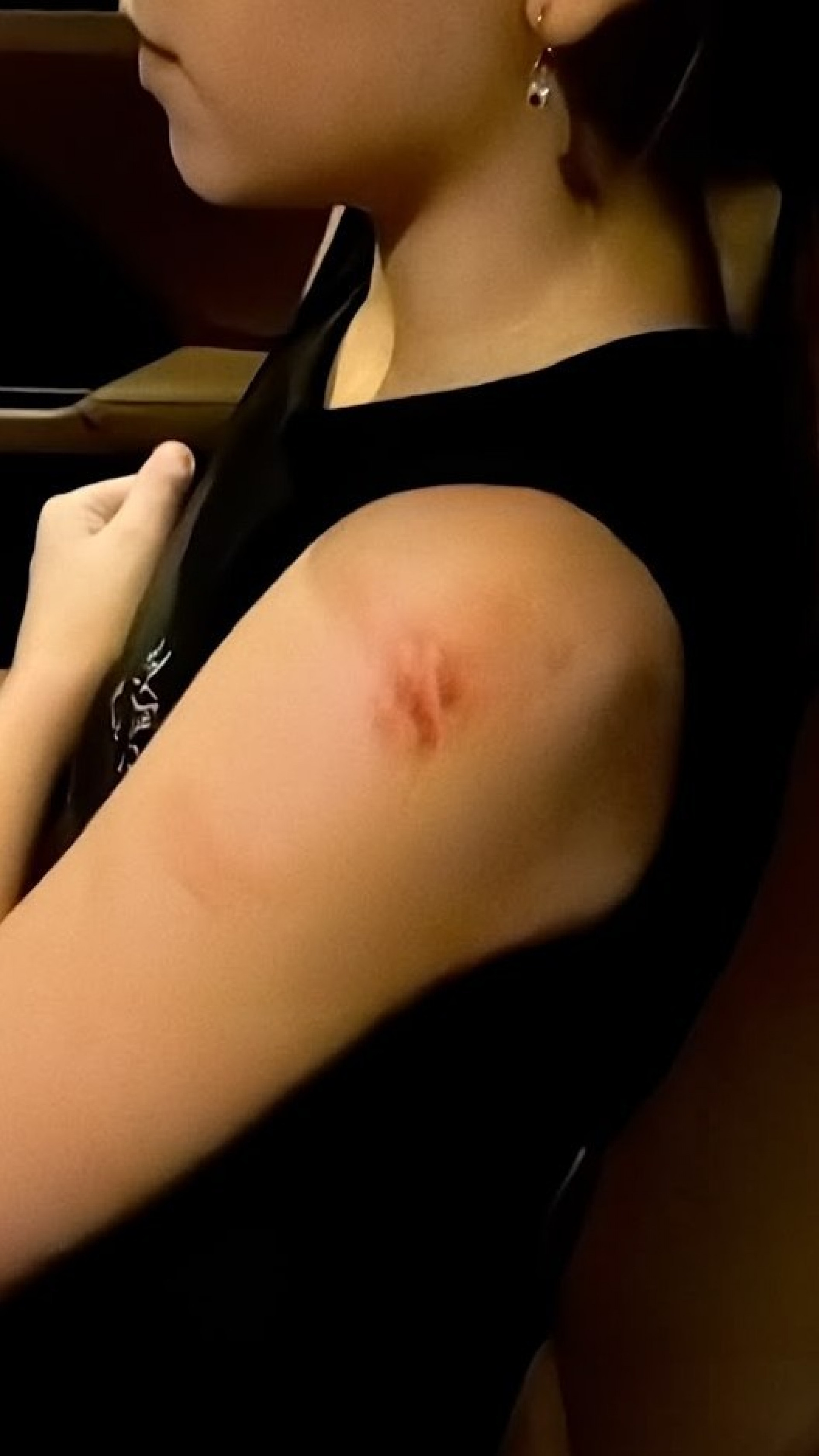 Menina ficou com cortes e uma lesão no pulmão, além de hematomas pelo corpo - Arquivo pessoal