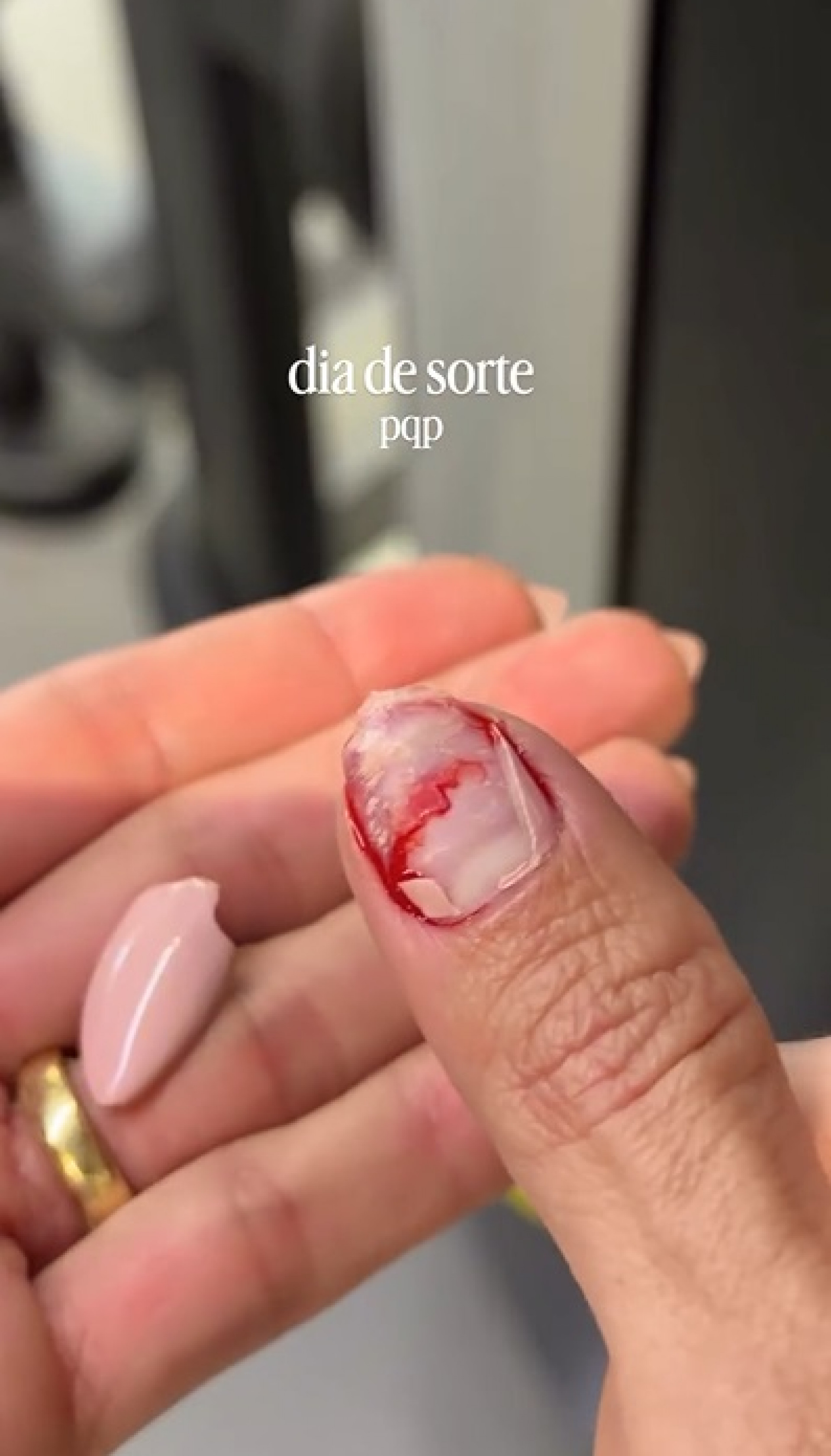 Aline Gotschalg surgiu com o dedo sangrando após quebrar a unha - Reprodução/Instagram