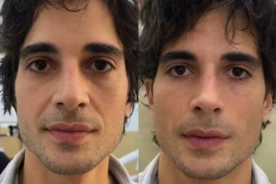 Fiuk mostra novo visual após harmonização facial