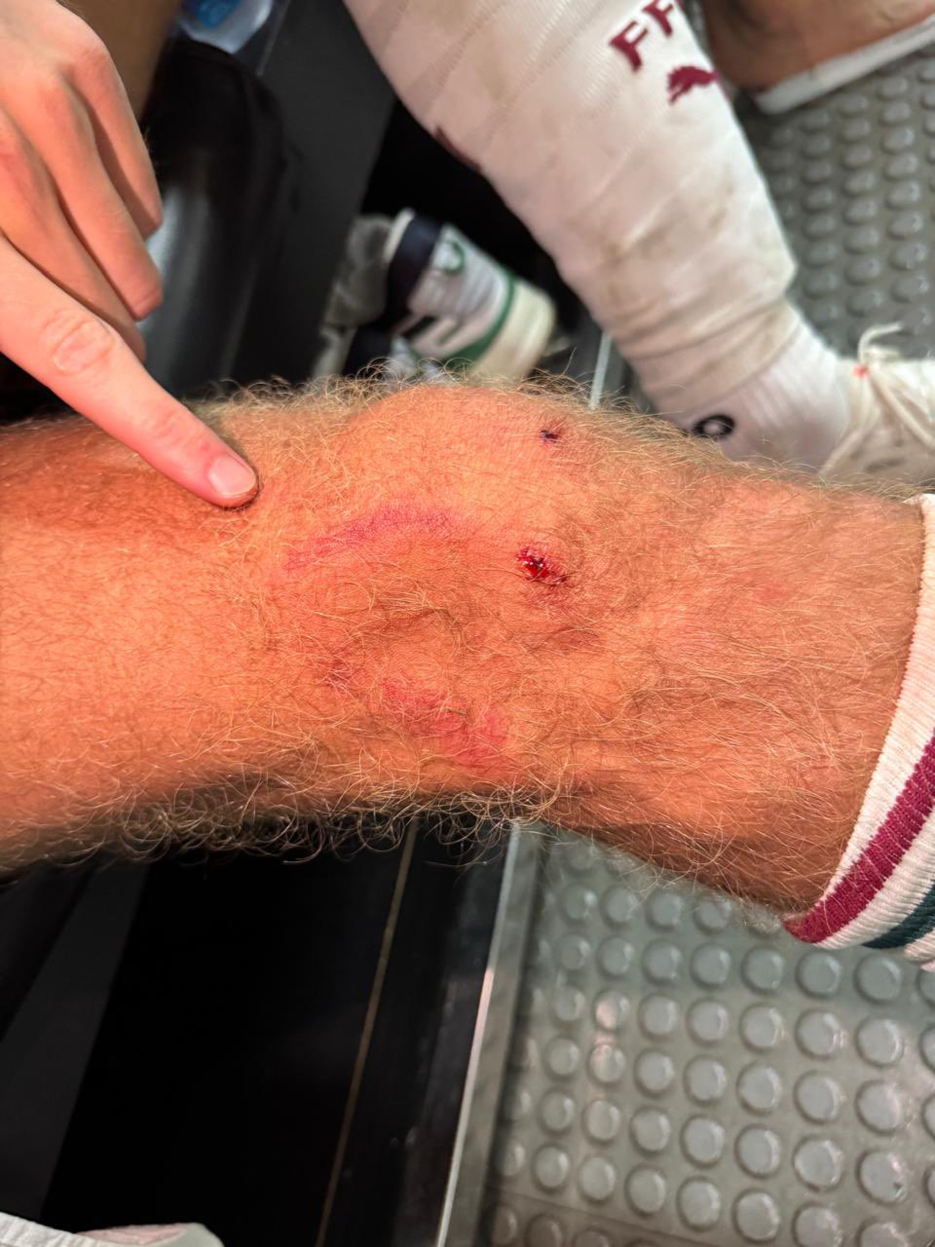 Fluminense divulgou foto do joelho de Castillo marcado após lance com Pulgar - Divulgação / Fluminense