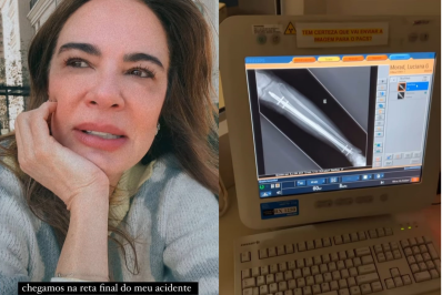 Luciana Gimenez realiza exame e se surpreende com recuperação da perna