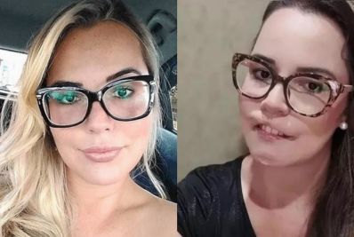 Influencer tem rosto deformado após procedimento estético e choca web