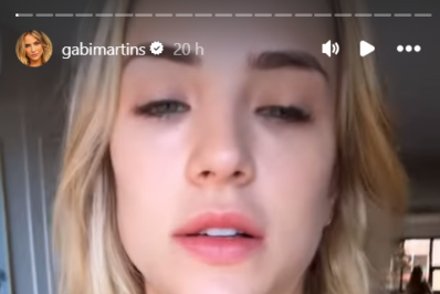 Gabi Martins mostra machucados provocados por fantasia de Carnaval: 'Todo ano fico assim'