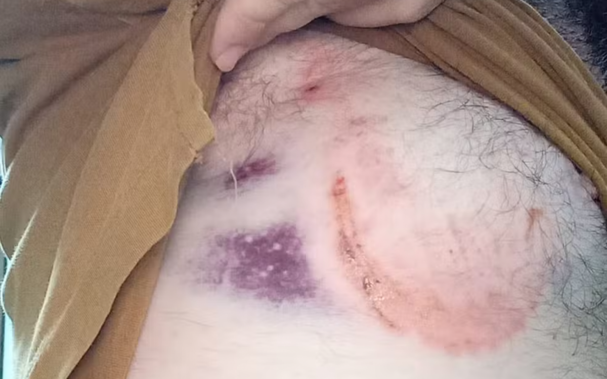 Machucado causado pela mordida do burro