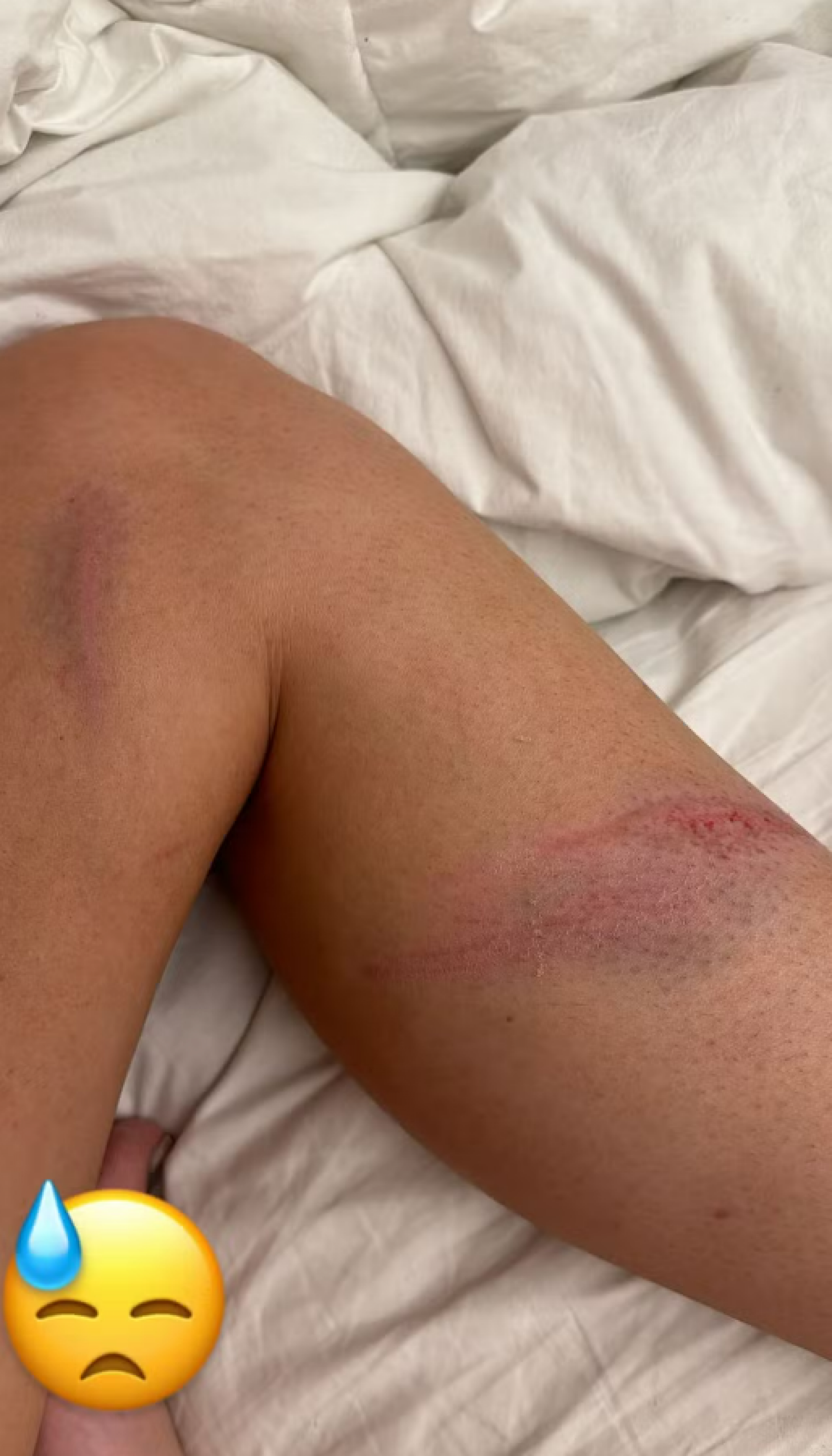 Emily Garcia exibe hematomas após ser \'atacada\' em briga por buquê