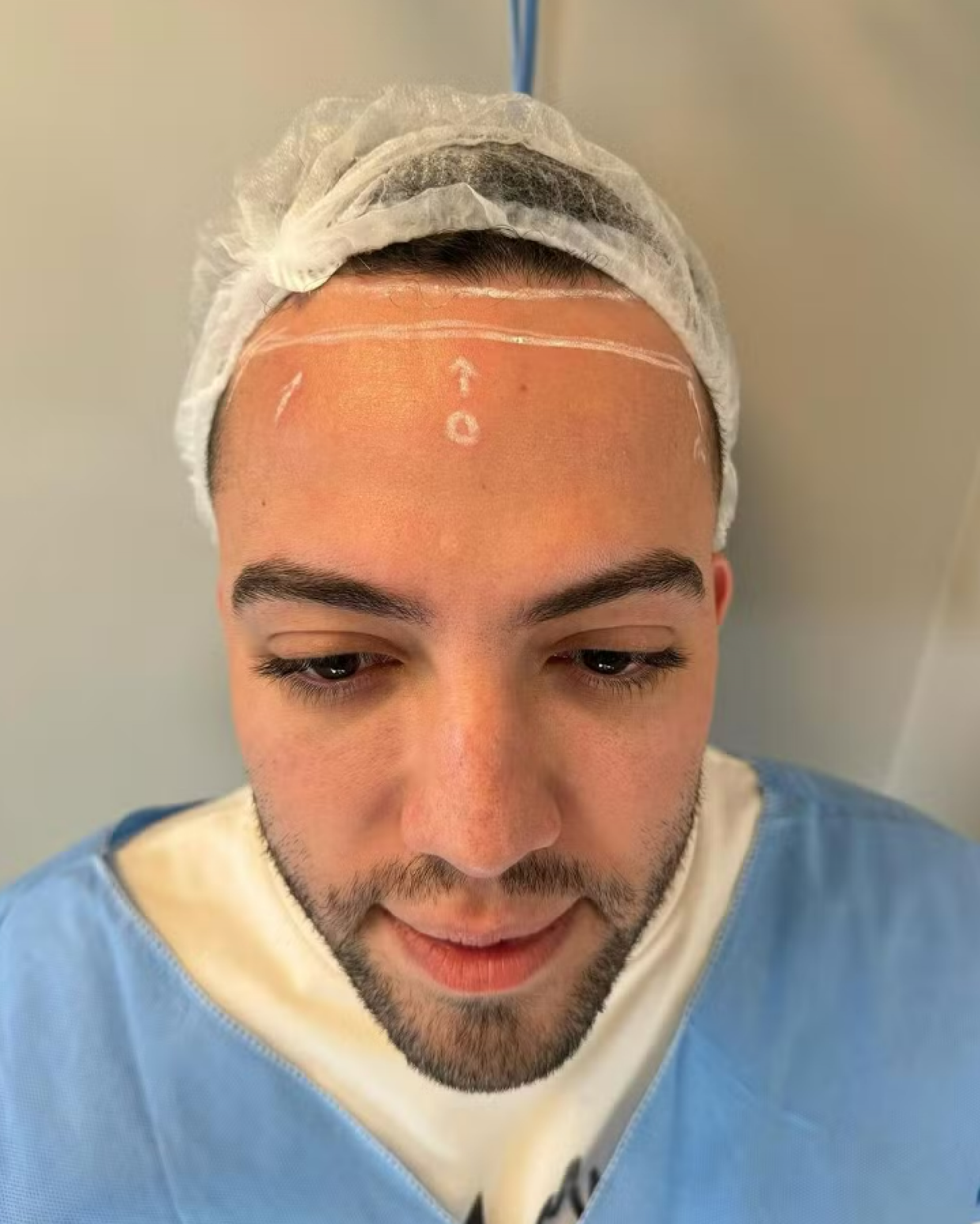 Lucas Rangel admite insegurança e faz cirurgia para diminuir testa - Foto: Reprodução