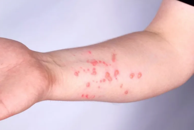 Suécia relata primeiro caso de cepa mortal de mpox fora da África