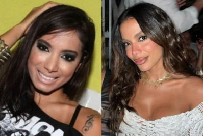 Anitta expõe procedimentos estéticos com antes e depois: 'Pobrezinha'