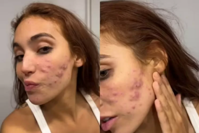 Vanessa Lopes desabafa sobre crise de acne: 'Autoestima lá embaixo'